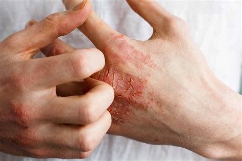 10 Ways How To Treat Eczema Causes Types And Natural Remedies