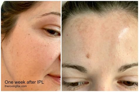 Ipl Treatment To Diminish Melasma And Facial Hyperpigmentation Ipl