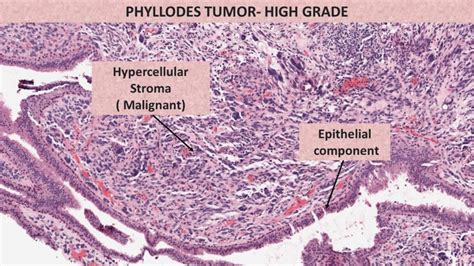 Phyllodes Tumor Pathology Made Simple