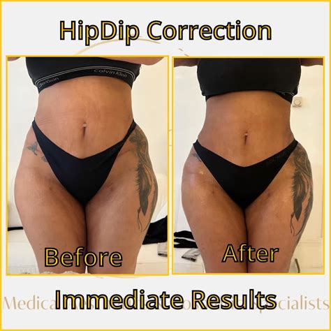 Hip Augmentation Hip Dip Non Surgical Bbl Breast Contouring And Hip Dip Correction