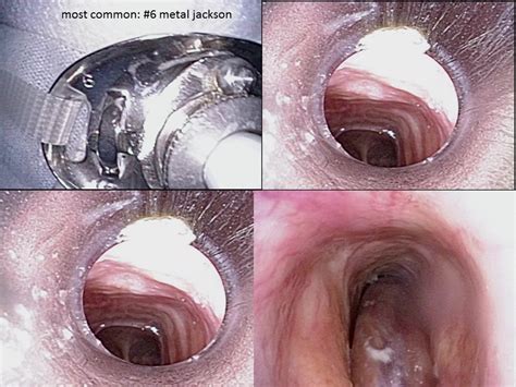 Hood Stoma Stent Tracheostomy Stent Iowa Head And Neck