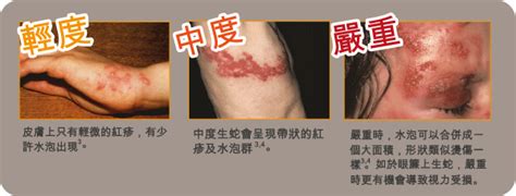 The site owner hides the web page description. 香港生蛇疫苗_生蛇疫苗预约接种_生蛇疫苗是什么_美亚香港医生预约网
