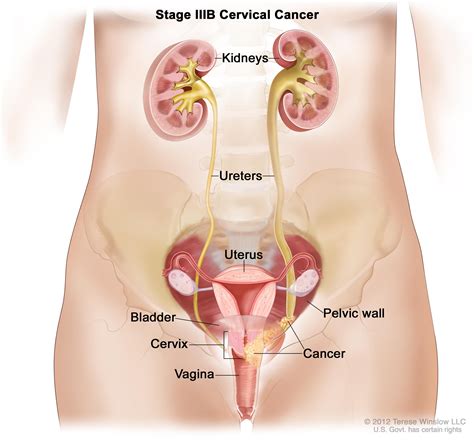 Kelsey, i had the same symptoms as you but it was a cyst on my ovary. Pin on Cervical Cancer
