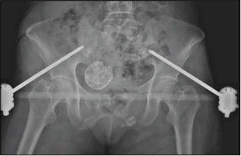 Anteroposterior Pelvis Radiograph Showing The External Fixator In Place