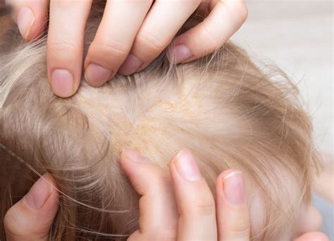 Choroby skóry głowy Rodzaje leczenie i wpływ na zdrowie włosów Kobieta w INTERIA PL