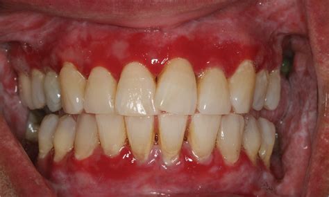Recurrent Gingival And Oral Mucosal Lesions Cardiology Jama Jama