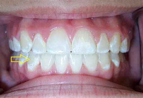 White Spots On Teeth After Whitening Teethwalls