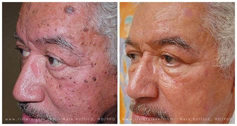 Syawa Nigma Age Spot Removal Before After Photos