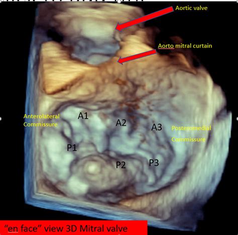 Figure En Face View Of Mitral Valve By D TEE Contributed By Vaibhav Bora MD StatPearls