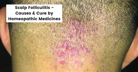Scalp Folliculitis Treatment Causes And Cure By Homeopathy