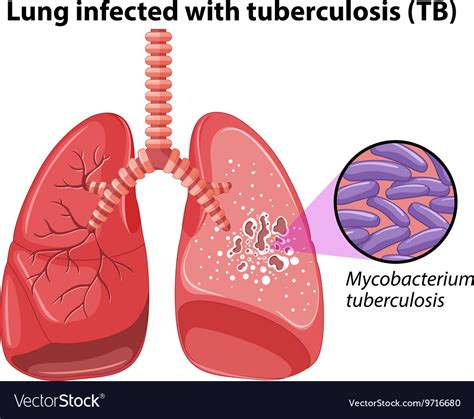 Lung Infected With Tuberculosis Royalty Free Vector Image