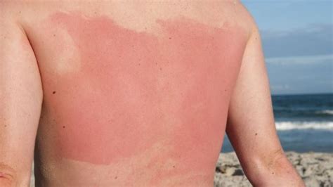 Could You Be Allergic To Sunscreen Skin Essentials