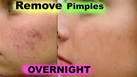 How To Remove Pimples From Face Naturally Fast At Home Youtube