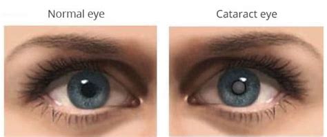 Cataract Atlas Eye