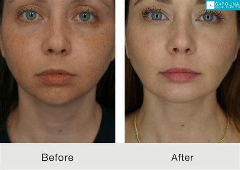 how to get rid of chubby cheeks we have solutions to this common concern carolina facial plastics