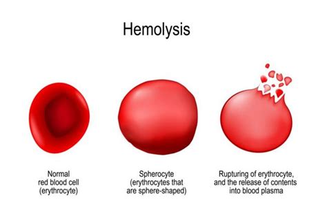 Causes Of High And Low Hemoglobin Levels Facty Health