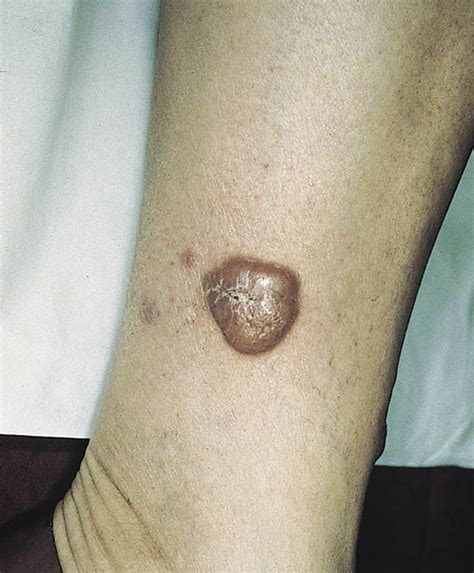 Primary Cutaneous Large B Cell Lymphoma Of The Leg Relapsing As Cutaneous Intravascular Large B