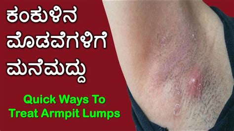 ಕಂಕುಳಿನ ಮೊಡವೆಗಳಿಗೆ ಮನೆಮದ್ದು Home Remedies For Armpit Lumps In Kannada