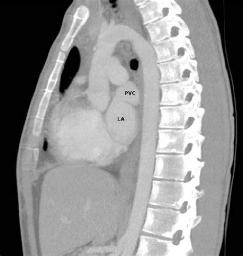 A Postoperative Three Dimensional Computed Tomography Angiography