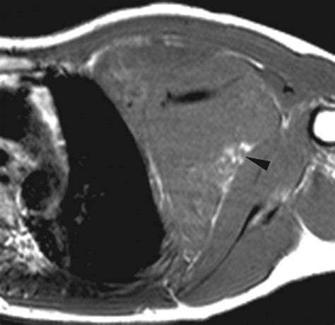 Imaging Of Primary Chest Wall Tumors With Radiologic Pathologic