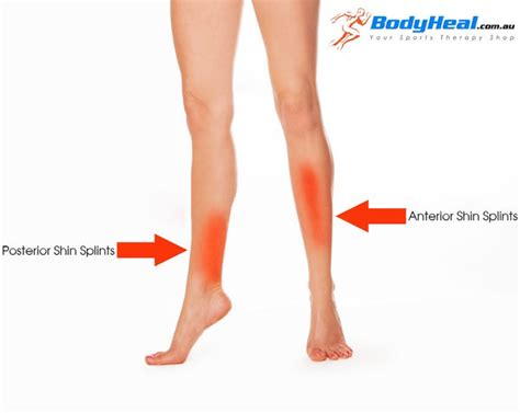What Is Shin Splints Causes Symptoms And Treatment Options Bodyheal