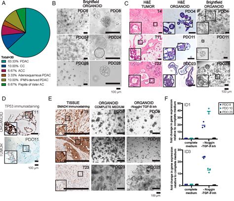 Figure 1 From Pancreatic Cancer Organoids Recapitulate Disease And