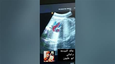 Foramen Ovale Aneurysm Fetal Ultrasound Youtube