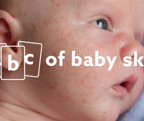 The A To Z Of Baby Skin Conditions Health Awareness