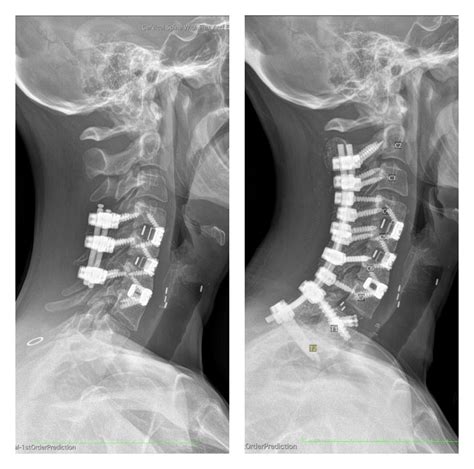 Case Study Anterior Cervical Discectomy And Fusion Dr Salvatore