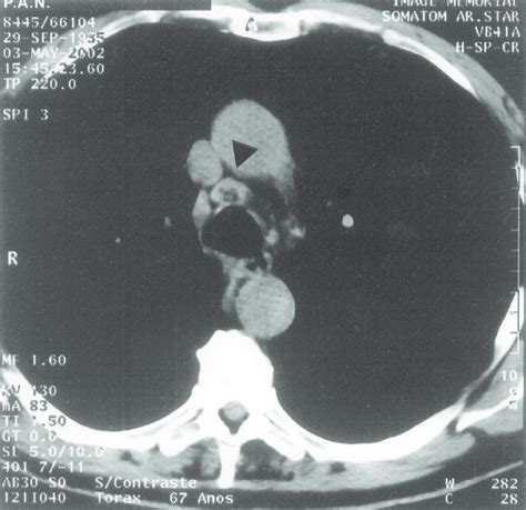 Case 1 Computed Tomographic Scan Of The Chest Showing A 17 Cm