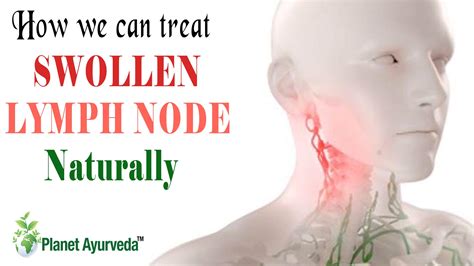 How We Can Treat Swollen Lymph Node Naturally Planet Ayurveda