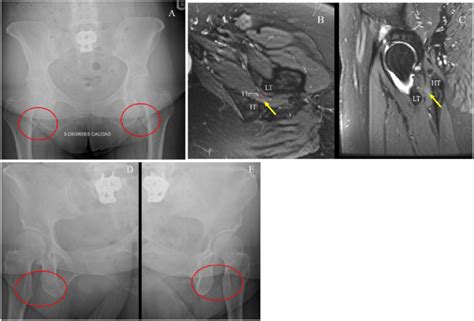 Ischiofemoral Impingement Diagnosed Following Unsuccessful Spinal