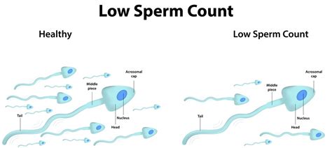 Low Sperm Count Private IVF Wandsworth Concept Fertility