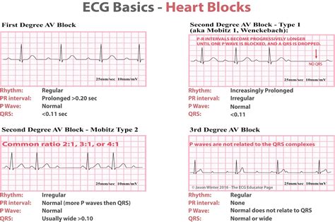 Ecg Educator Blog Heart Blocks