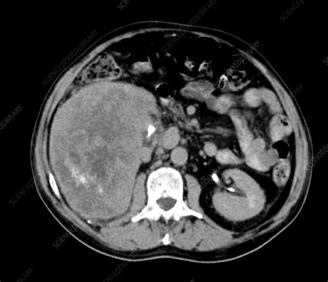 Kidney Cancer Ct Scan Stock Image C0525642 Science Photo Library