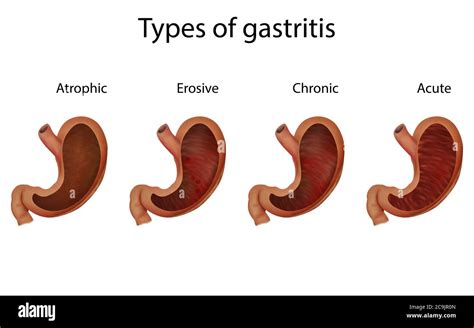 Chronic And Atrophic Gastritis Hi Res Stock Photography And Images Alamy