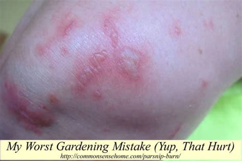 My Worst Gardening Mistake Parsnip Burn Aka Phytophotodermatitis