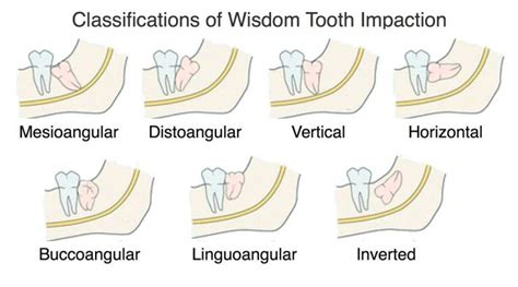 Impacted Wisdom Teeth Everything You Should Know Keemsmile