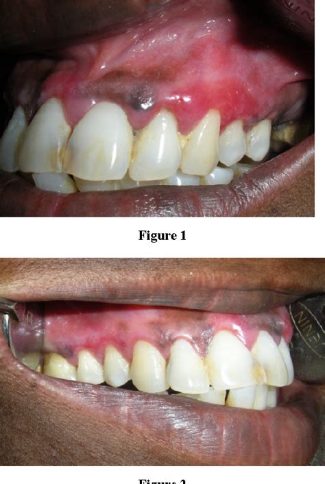 Figure 1 From Oral Signs In Mucocutaneous Disorders Report Of Three