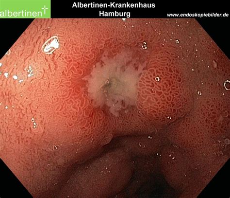 Duodenal Bulb Ulcer