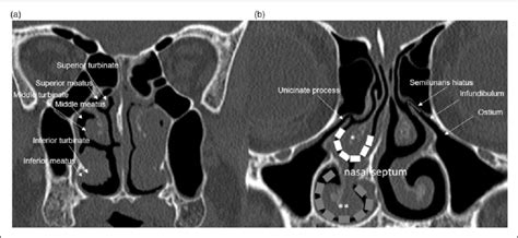 Anatomy Of The Nasal Turbinates And Meatuses A Nasal Polyposis