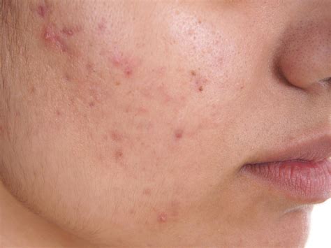 Roaccutane Warnings Over Acne Drug Linked To Suicide Risk After