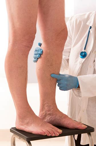 Usually the symptoms of a blood clot in the leg affect only one leg. blood clots | Health Beat