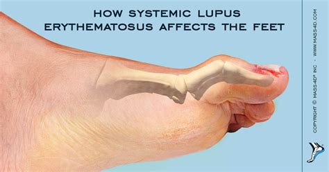 How Systemic Lupus Erythematosus Affects The Feet Mass4d® Foot Orthotics