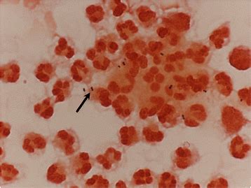 Gram Stain Of The Csf Showed Streptococcus Pneumoniae Black Arrow In