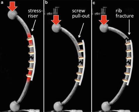 Biomechanics Of Rib Fracture Fixation Thoracic Key