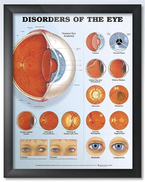 Disorders Of The Eye 20x26 Anatomy Poster Eye Anatomy Human Anatomy