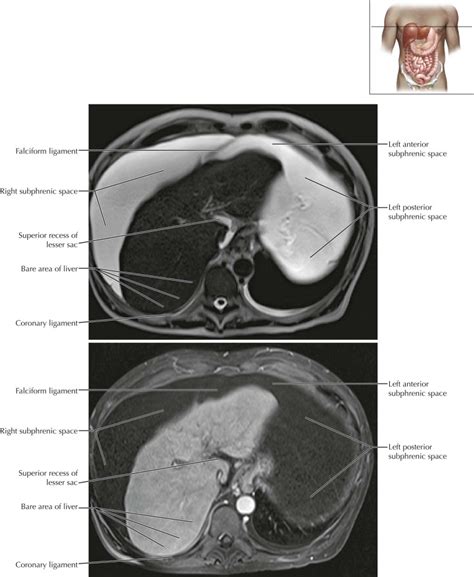 Peritoneal Cavity Radiology Key