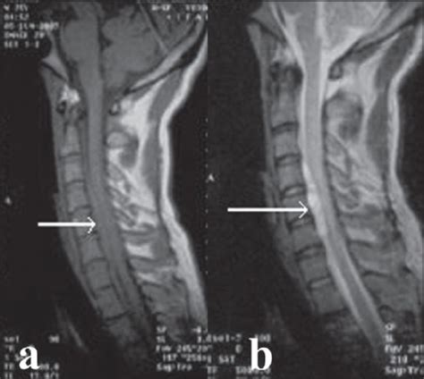 Mid Sagittal T1 A And T2 B Weighted Mri Of Cervical Open I