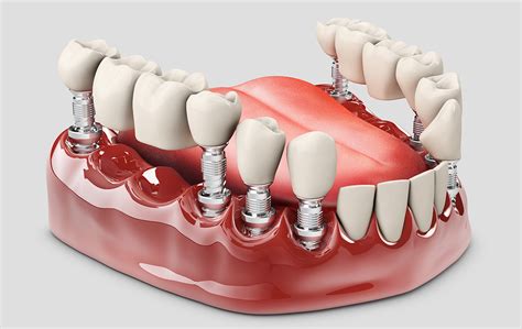What Are Fixed Partial Dentures Los Angeles Ca Dentures